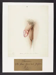 Hospice: Chancre of Glans Penis and Prepuce