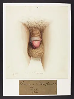 Hospice: Chancre and Paraphimosis