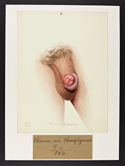 Hospice: Chancre and Paraphimosis