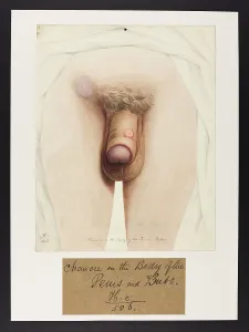 Hospice: Chancre on Penis, Bubo