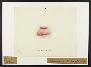 Hospice: Chancre of Upper Lip