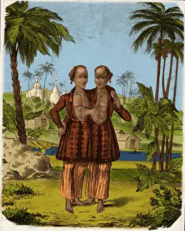 Disability: Chang and Eng, Siamese Twins