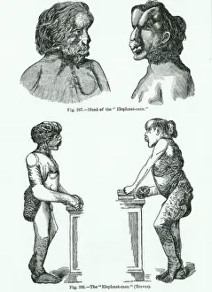 Curiosities: Charles Merrick, the Elephant Man Engraving from
