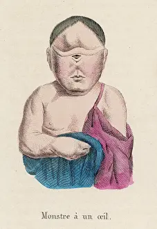 Deformities: CHILD WITH ONE EYE