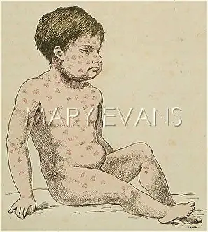 Onset: CHILD WITH MEASLES/1883