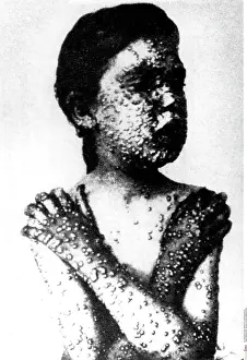 Pustules: Child with smallpox