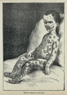 Ailments: Child with Smallpox