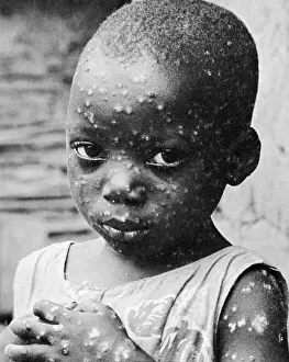 Smallpox: Child With Smallpox