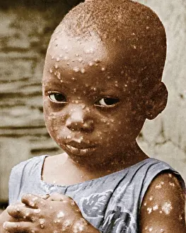 Smallpox: Child With Smallpox