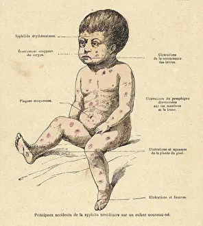 Syphilis: CHILD WITH SYPHILIS
