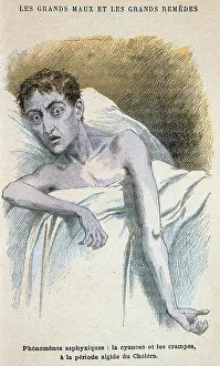 Cholera: Cholera: Patient in typical cholera attitude