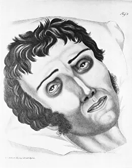 Cholera: Cholera Victim, 1831