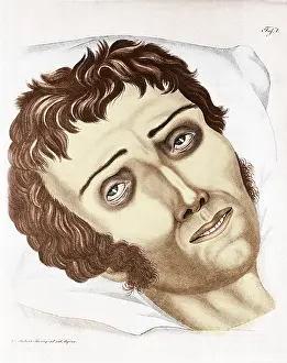 Cholera: Cholera Victim, 1831