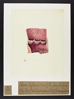 Verso: Chronic Inflammation of Inner Surface of Heart