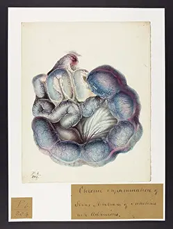 Membrane: Chronic Inflammation of Serous Membrane of Intestines