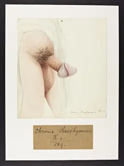 Hospice: Chronic Paraphimosis