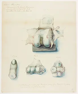 Novr: Chronic rheumatism