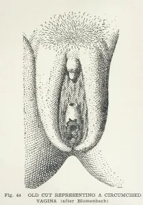 Circumcision: CIRCUMCISION 1775