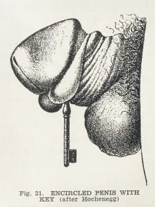 Circumcision: CIRCUMCISION