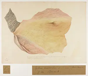 Fever: Circumscribed Yellow Discolouration, Stomach Mucous Membrane