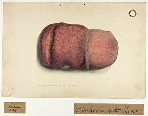 Liver: Cirrhose of Liver Accompanied with Ascites