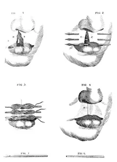 Deformity: Cleft Lip Surgery, 1791