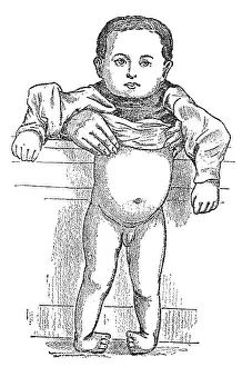 Deformities: Clubfoot before therapy, 1902