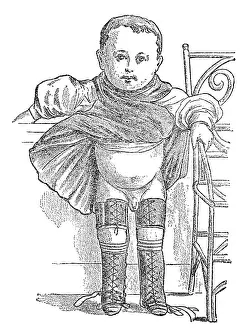 Deformities: Clubfoot during therapy, 1902