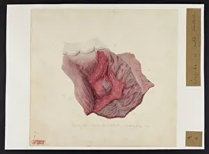 Hopital: Coagula in Right Ventricle