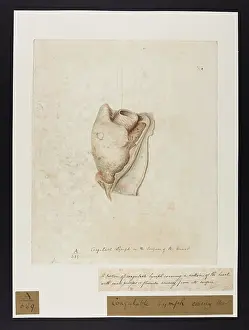 Unsigned: Coagulable Lymph Covering Heart