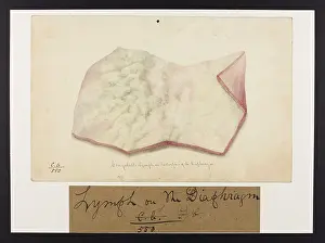 Diaphragm: Coagulable Lymph on the Diaphragm