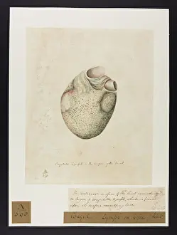 Unsigned: Coagulable Lymph on Surface of Heart