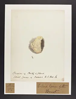 Ucl Library Services Digital Collections: Colloid Cancer of Breast