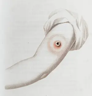 Immunology: Coloured depiction of lesion on arm