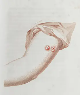 Immunology: Coloured depiction of lesion on arm