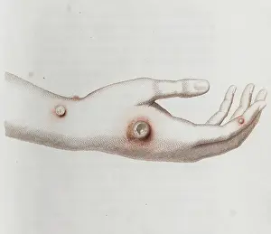 Immunology: Coloured depiction of lesion on a hand