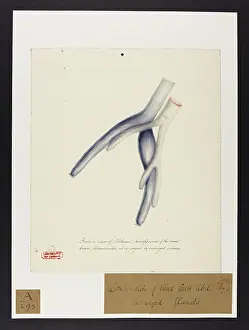 Phthisis: Compression of Vena Cava Abdominalis