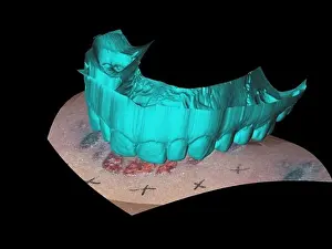 Forensic: Computer Reconstruction of Bite Mark