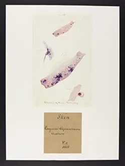 Blank: Congenital Elephantiasis