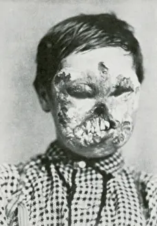 Deformed: Congenital Syphilis