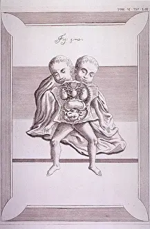 Dissected: Conjoined twins with common torso and limbs, ?