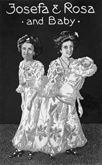 Rosas: Conjoined twins Josefa and Rosa Blazek