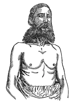 Pulmonary: Consumptive chest, 1902