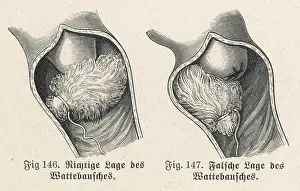 Correct: CONTRACEPTION/1905