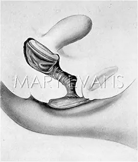 Correctly: CONTRACEPTION/CAP/1931