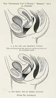 Correct: CONTRACEPTION/DIAPHRAGM
