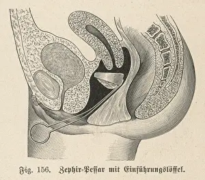 Resembles: CONTRACEPTION/ZEPHIR CAP