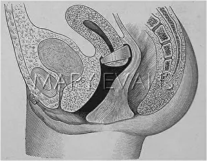 Correctly: CONTRACEPTION/ZEPHIR CAP