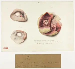 Contraction: Contraction of Both Auriculo-Ventricular Orifices