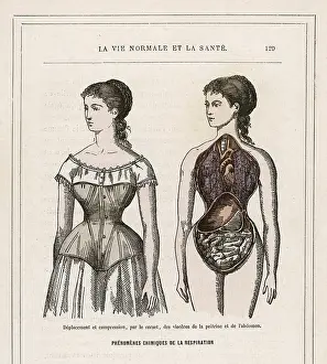 Deformity: What Corsets Do
